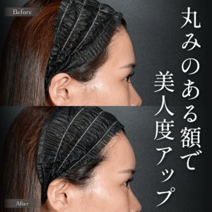 ヒアルロン酸注入