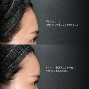 ヒアルロン酸注入