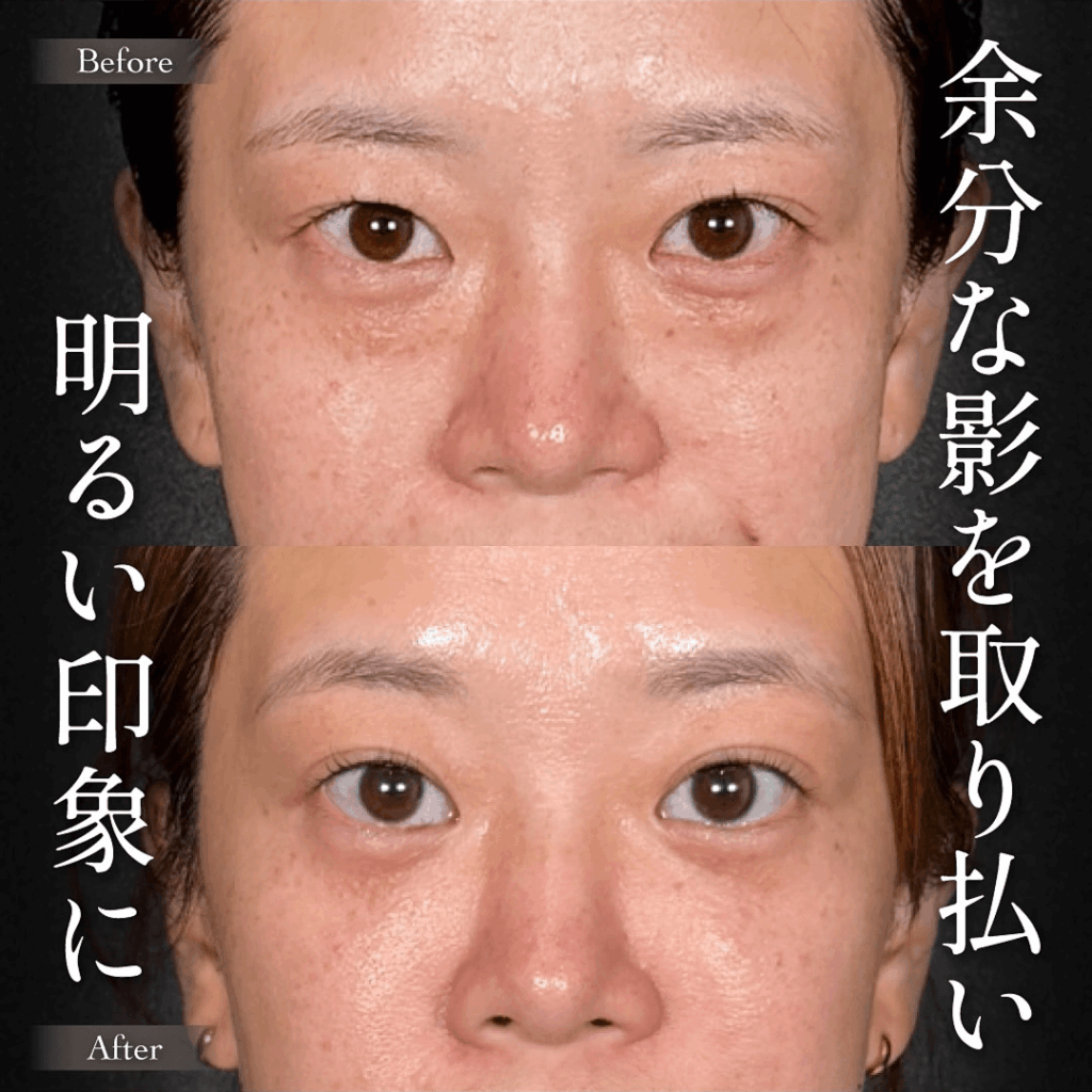 Mirrora式クマ取り ヒアルロン酸