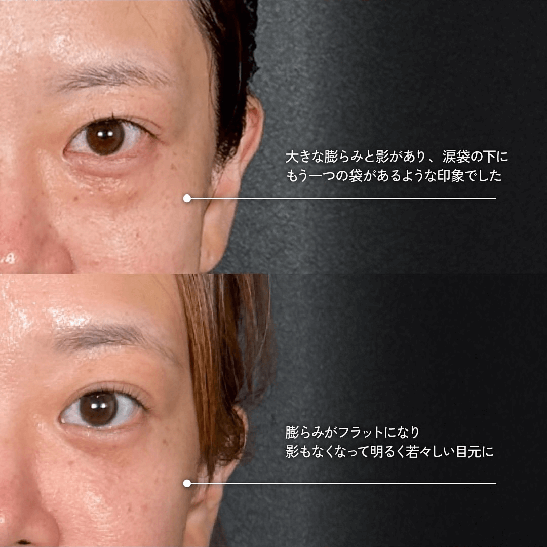 Mirrora式クマ取り ヒアルロン酸